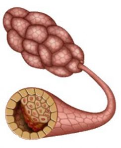 DCIS (Ductal Carcinoma in Situ)