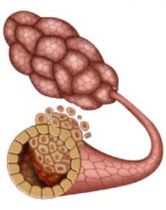 INVASIVE CANCER Cancer progresses out of the duct spreading to breast tissue