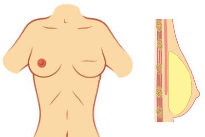 breast implant