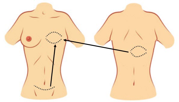 breast tissue transfer