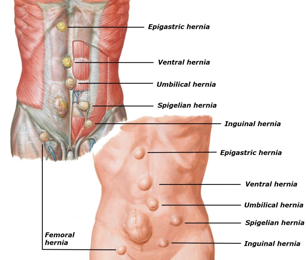 Hernia Surgery